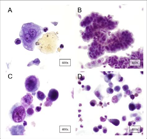 Urine Cytology Findings Of A Normal B Low Grade Urothelial