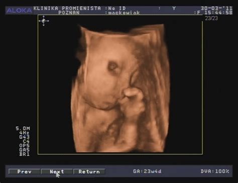 Według autora pracy zamieszczonej na łamach pisma ultrasound. Klinika Promienista Poznań