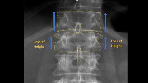 Lumbar X Ray Interpretation Osce Guide Radiology Geeky Medics