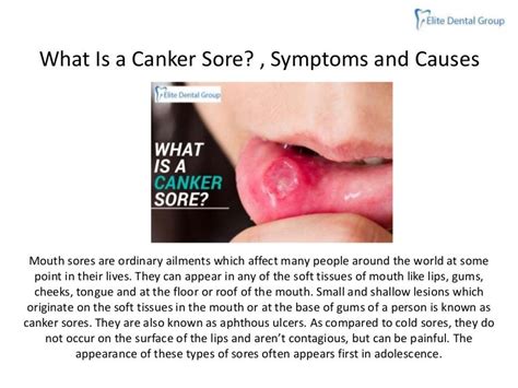 What Is A Canker Sore Symptoms And Causes Of Canker Sore