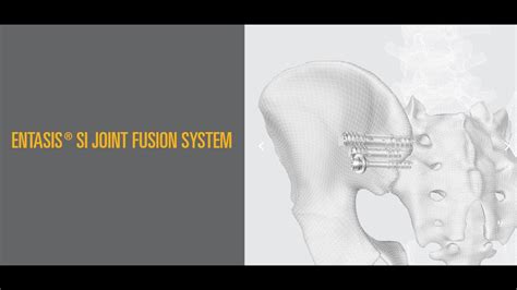 Corelink Surgical Entasis Sacroiliac Joint Fusion Youtube