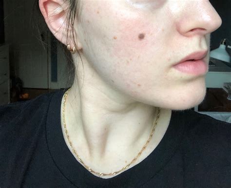 My Tretinoin Journey How I Finally Cured My Hormonal Acne