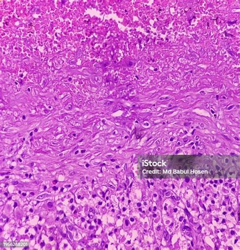 Ovarian Cyst Haemorrhagic Cyst Microscopic Show Ovarian Cyst Wall Of Fibrocollagenous Tissu