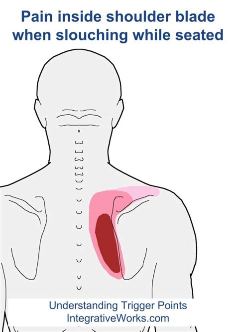 Pin On Shoulder Trigger Point Pain