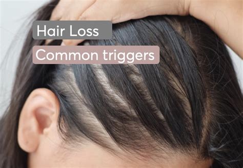 Aggregate More Than 82 Excessive Hair Fall Causes Super Hot In Eteachers