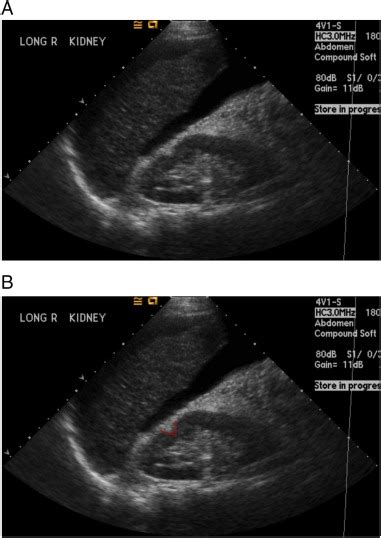 Pictorial Review Renal Ultrasound Clinical Imaging