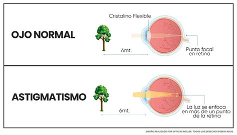 Qu Es El Astigmatismo Opticas M Ller