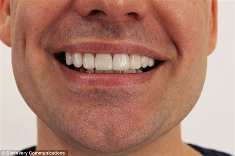 Extreme Beauty Disasters Shows Man Who Had Bad Teeth Veneers Repaired