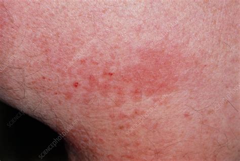 close up of lichen planus on skin stock image m200 0077 science photo library