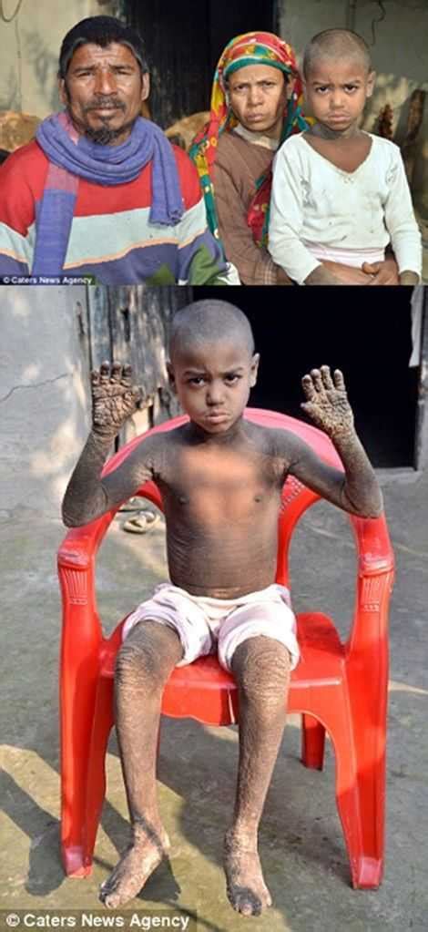 Meet The Eight Year Old Boy Who Is Turning Into Stone Social