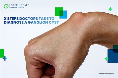 Six Steps To Diagnose A Ganglion Cyst Best Best Health System