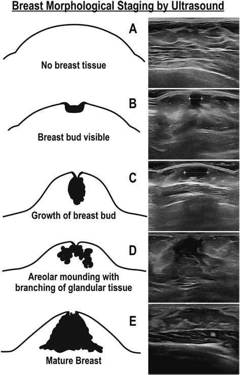 Budding Breast Pictures Telegraph