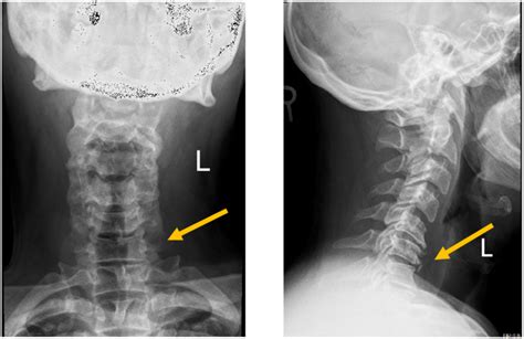 X Ray Antero Posterior And Lateral Views Of Cervical Spine Showing