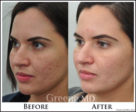 El tratamiento con láser logra quitar las marcas de acné de la cara para siempre. Acne Scar Treatment Options Weston, Fort Lauderdale, Miami ...