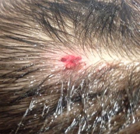 Trick Of The Trade Parting The Hair For Scalp Laceration Repair