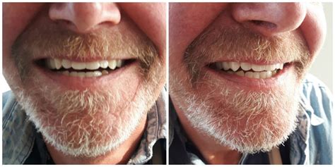 Complete Upper Denture And Partial Lower Denture Kelowna Denture Clinic
