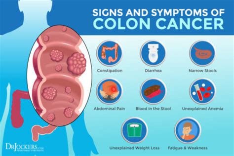 Colon Cancer Symptoms Causes And Support Strategies
