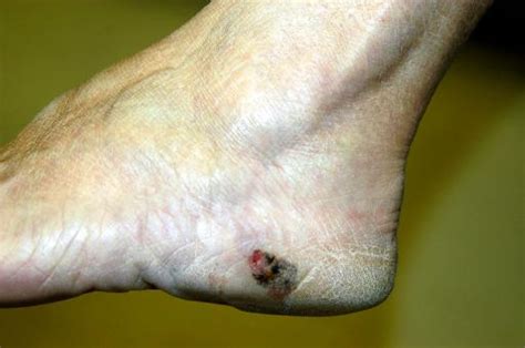Melanoma Foot