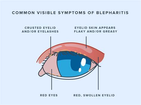 Blepharitis Symptoms Causes And Treatment Warby Parker