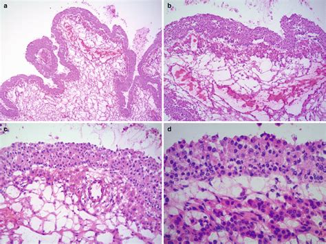 nonneoplastic lesions of the ovary and miscellaneous primary ovarian tumors basicmedical key