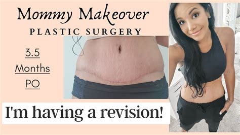 Revision Mommy Makeover Plastic Surgery 35 Mo Po Scar Update Youtube