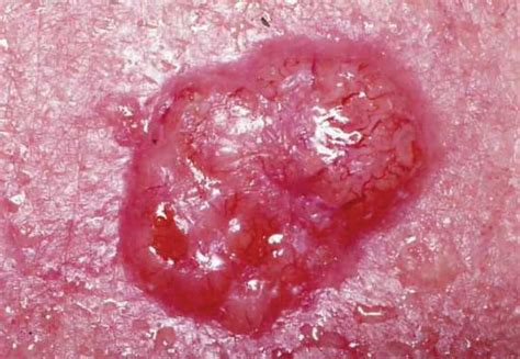 Basal Cell Carcinoma Vs Squamous Cell Carcinoma Bcc Vs Scc Cm