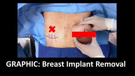 graphic en bloc capsulectomy implant removal w explanation youtube