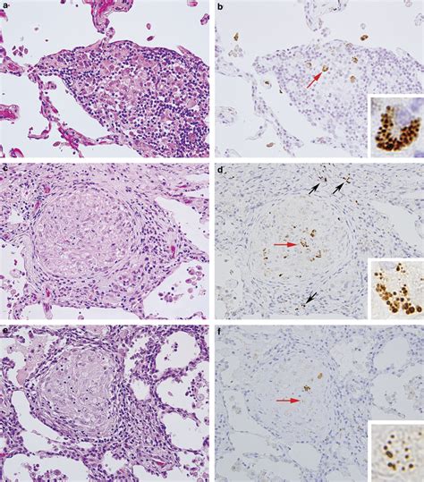 P Acnes Within Sarcoid Granulomas Of The Lungs Hematoxylin And Eosin