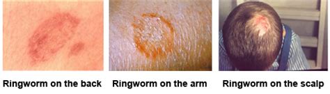 Symptoms Of Ringworm Ringworm Types Of Diseases Fungal Diseases Cdc