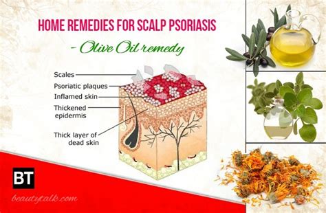 16 Best Natural Home Remedies For Scalp Psoriasis
