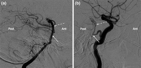 Magnified Diagnostic Cerebral Angiogram Injections Of The A Right