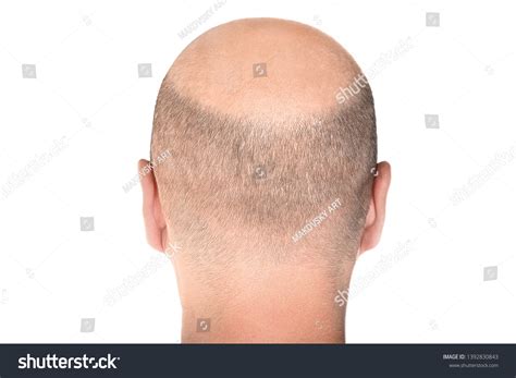 Concept Hair Loss Back View Balding Stock Photo 1392830843 Shutterstock