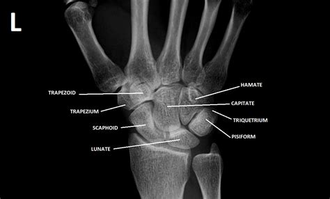 Wrist Anatomy Radiology