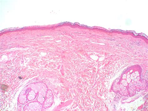 Virtual Grand Rounds In Dermatology 20 Unusual Pigmentary Process
