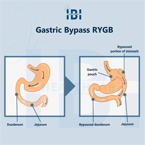 Long Term Diet After Gastric Bypass Surgery