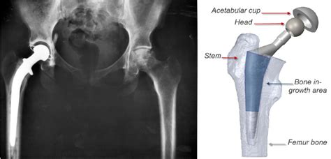 Left Total Hip Replacement Thr Courtesy Of National Institute Of