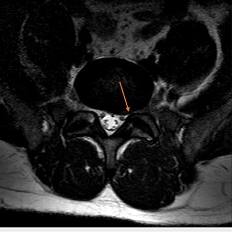 Mri Of The Lumbar Spine Showed Degenerative Retrolisthesis Of L On S