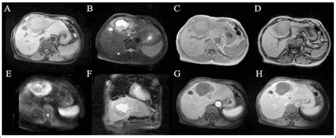 The Different Sequences Of Mri Showing The Hepatic Abscess In The Area