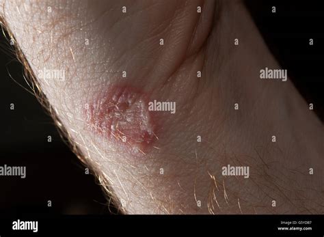 Ringworm On White Man Skin Fungus Infection Mycosis Stock Photo
