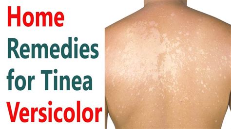 Top Natural Home Remedies For Tinea Versicolor Health Blog