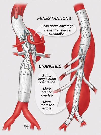 Sizing And Planning Fenestrated And Multibranched Endovascular Repair
