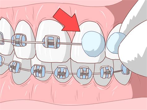 How to glue in a dental bridge. How to Avoid Pain When Your Braces Are Tightened: 14 Steps