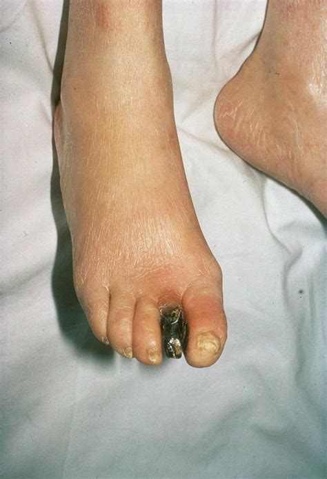 Gangrenous Toe In Diabetes Photograph By St Bartholomew Hospital