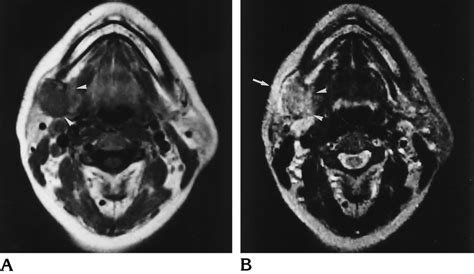 Acute Sialadenitis In A 45 Yearold Woman A Axial T1 Weighted Mr Image
