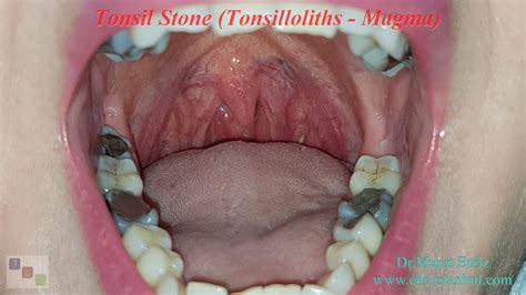 How To Know If You Have Tonsil Stones Tonsil Stones Home Remedy 10
