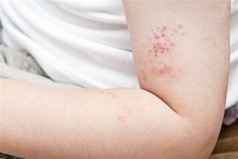Early Signs You May Have Shingles Learn The Symptoms And Treatment