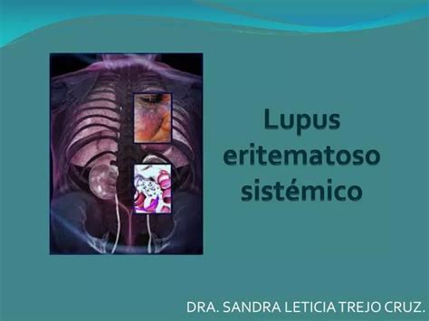 PPT Lupus eritematoso sistémico PowerPoint Presentation free