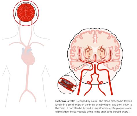 A stroke occurs when a blood vessel that carries oxygen and nutrients to the brain is either. Stroke - World Heart Federation