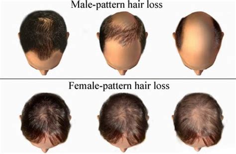 6 Signs Of Hair Loss In Women