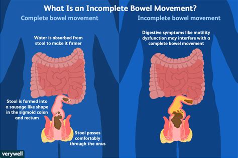 What to do if your child has faecal impaction? Can T Pass Stool - Stools Item